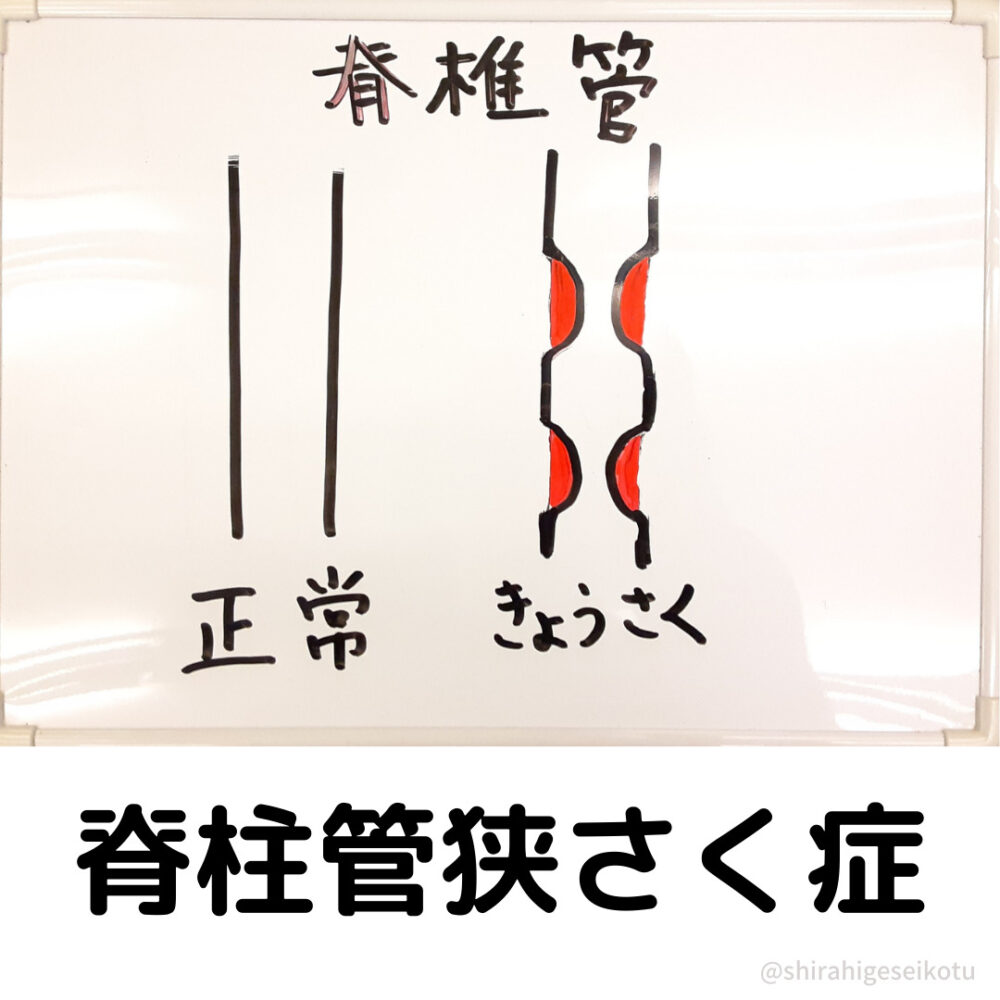 脊柱管狭さく症　狭さくする